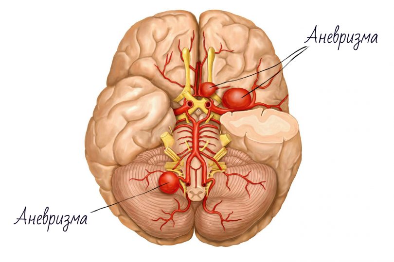 Аневризма головного мозга: последствия после операции, отзывы