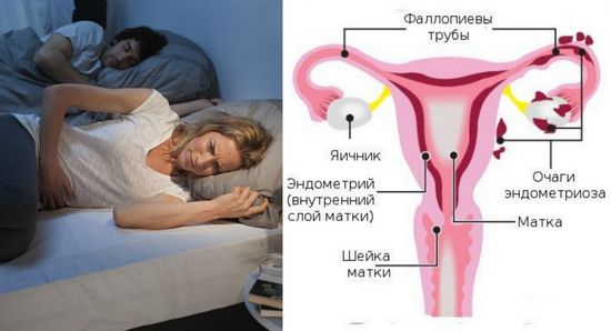 Эндометриоз: симптомы и лечение у женщин
