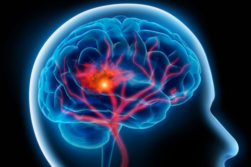 Можно ли укрепить сосуды головного мозга?