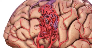 Лечится ли венозная ангиома головного мозга?
