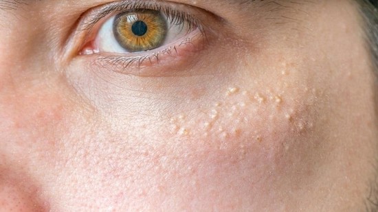 Разновидности жировиков на лице