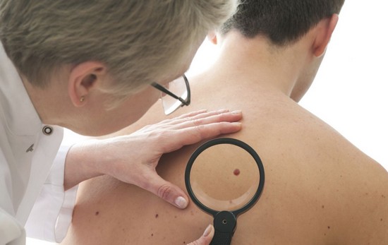 невусы имеют темный цвет