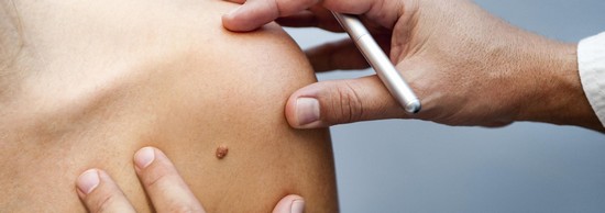 Причины появления родинок