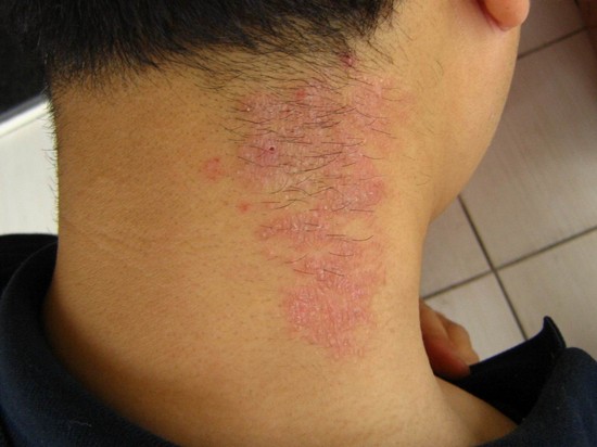 Для чего применяется мазь Синафлан