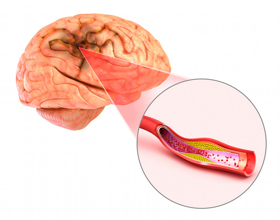 Чем отличается инсульт от инфаркта? Что хуже?