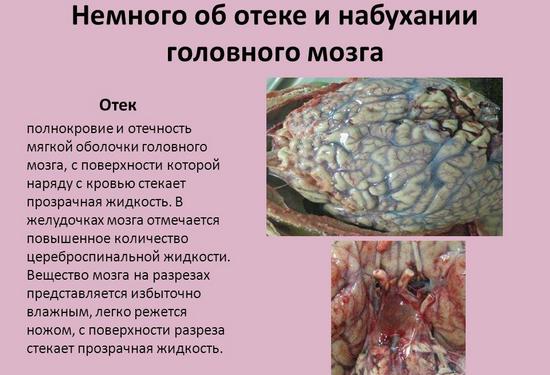 Отек головного мозга: причины и последствия